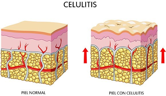 ¿Que es la celulitis?